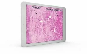 fibrose adx 2