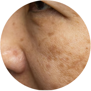 melasma