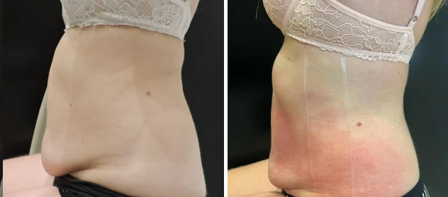 antes depois ana 2
