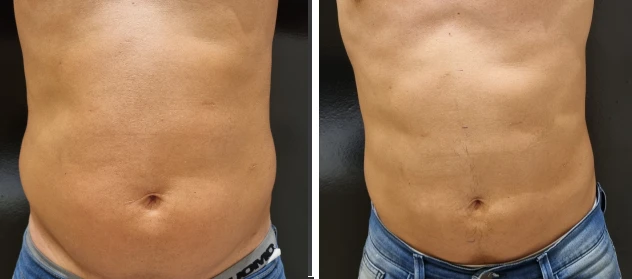 antes depois gabriel
