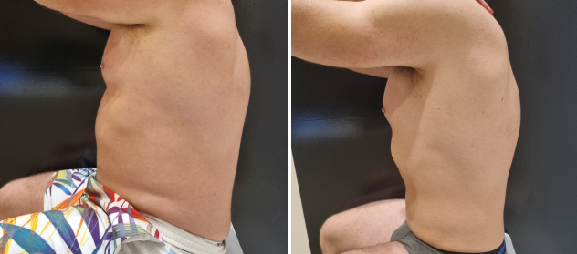 antes depois patrick 2 1